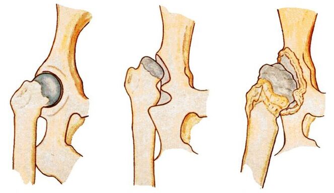 Hip dysplasia is a cause of secondary coxarthrosis