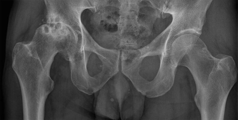 Stage 3 osteoarthritis of the hip joint on x-ray
