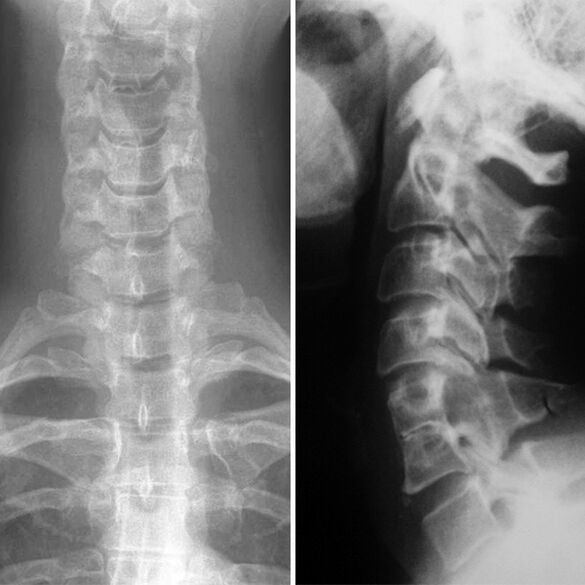 X -Ray the cervical spine