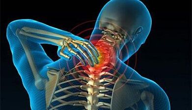 Symptoms of osteochondrosis of the cervical spine