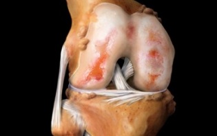 What is osteoarthritis of the knee