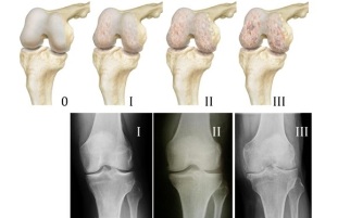 Methods of diagnosing osteoarthritis of the knee