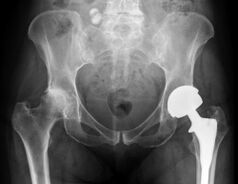 Diagnosis of osteoarthritis of the hip joint