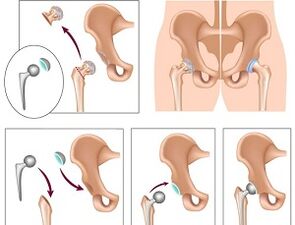 Endoprosthetics for osteoarthritis of the hip joint