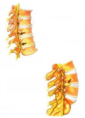 Illustration of osteochondrosis of the spine