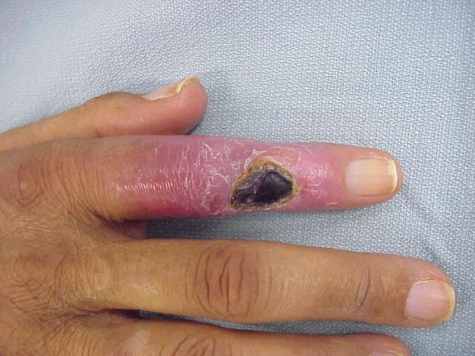 Osteomyelitis as a cause of pain in the finger joints
