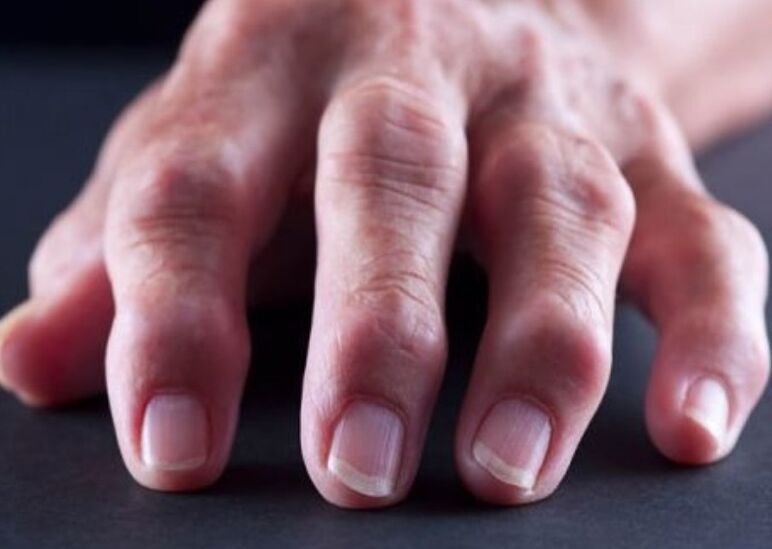 rheumatoid arthritis as a cause of pain in the finger joints