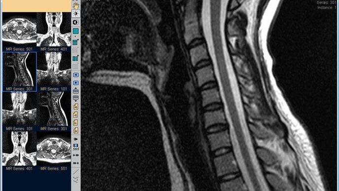 An MRI of the cervical spine is the best way to diagnose neck pain