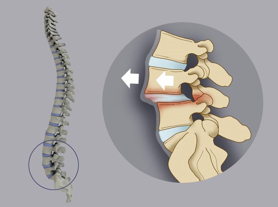 Displacement of the vertebrae as a cause of back pain