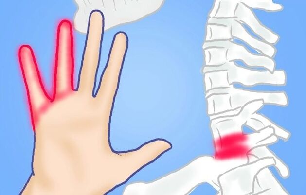 Pinched nerves as a cause of back pain