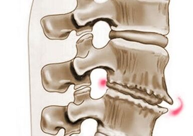 Vertebral damage in thoracic osteochondrosis